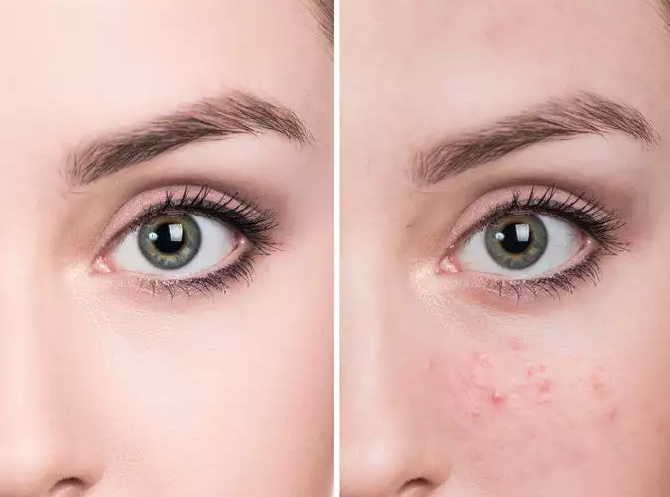 پوشاندن جای جوش با آرایش